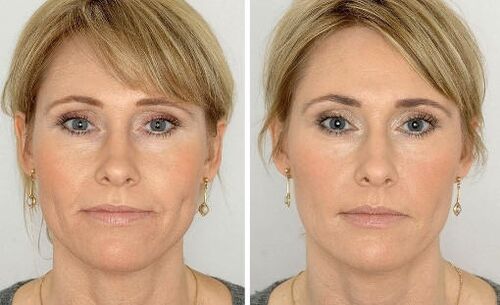 Pictures before and after using the cream, experience using Coralift Valerie from Paris