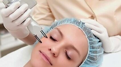 A facial laser rejuvenation