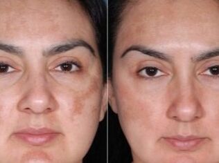 Before and after rejuvenating procedures